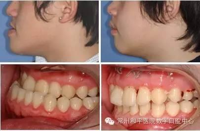 成人纠正斜颈视频,跟随专业视频教程，重塑颈部健康