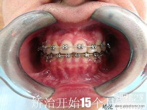 成人拔牙完整视频教程,成人拔牙操作步骤详解视频教程